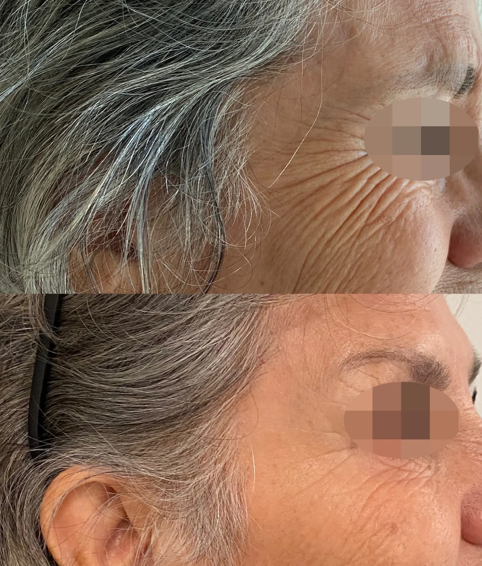 Resultado facial